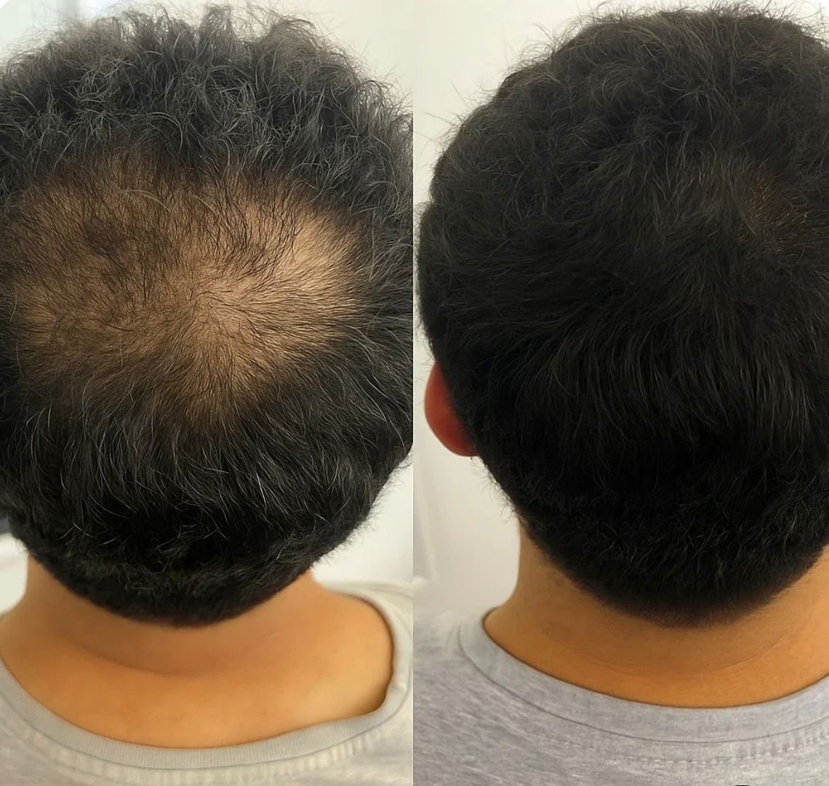 RBS Collective FollicleFX®